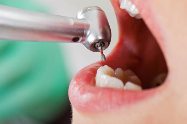 Best Emergency Wisdom Teeth Removal in Hayfork, CA